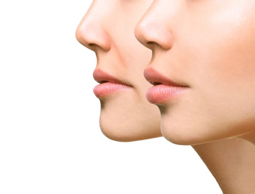 Answers to Your Questions About Lip Augmentation